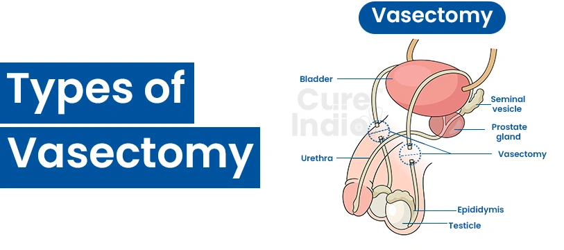 Types of Vasectomy Surgery